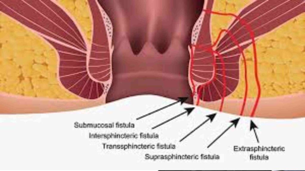 fistula treatment without surgery