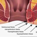 fistula treatment without surgery